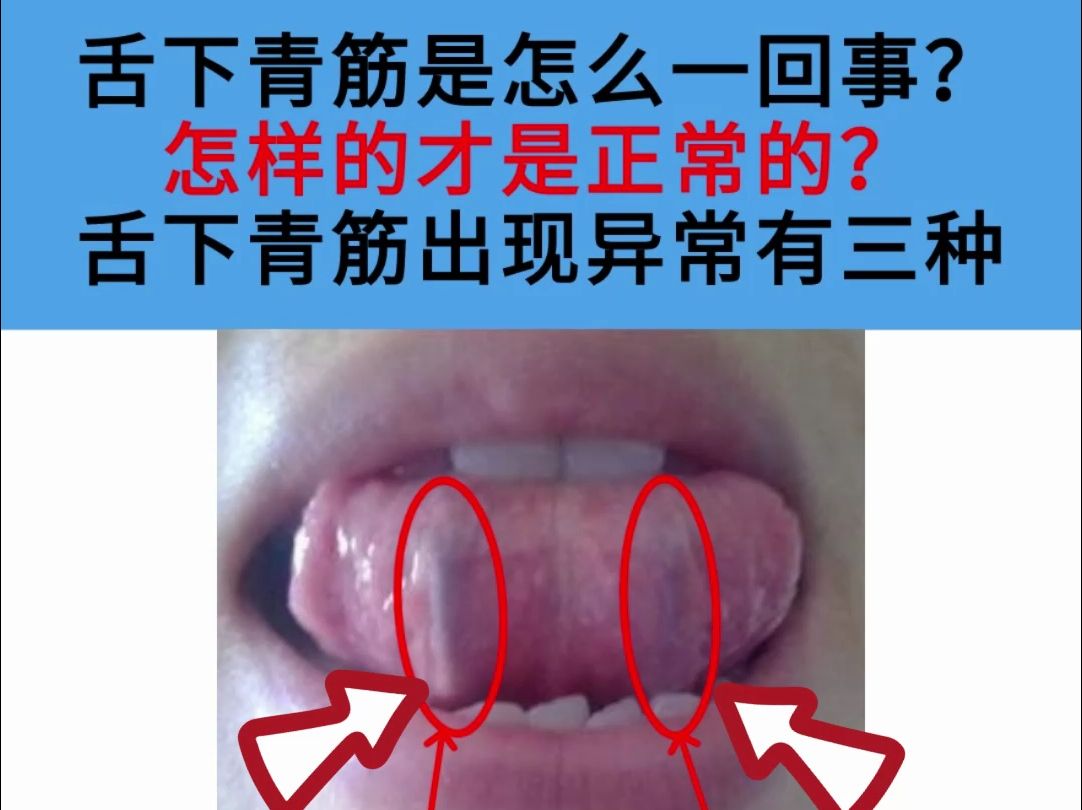 舌象分析:舌下青筋是怎么一回事?怎样的才是正常的?哔哩哔哩bilibili