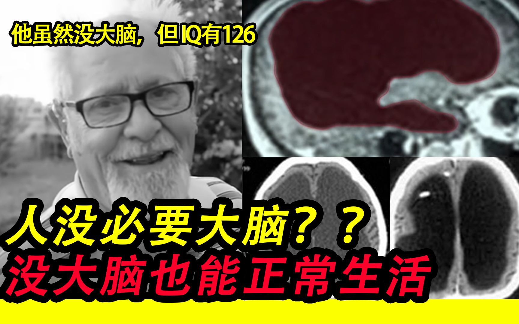 [图]【神秘事实】天才数学系学生检查发现竟然没大脑！| 这人，，，活了40年才知道自己没大脑，，