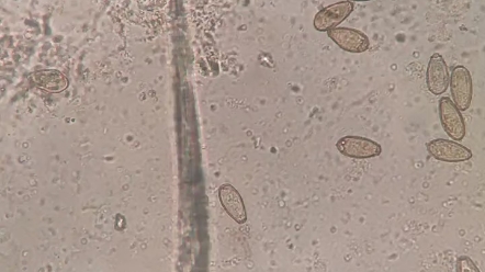 内容可能引起不适,华支睾吸虫虫卵400*镜下观察哔哩哔哩bilibili