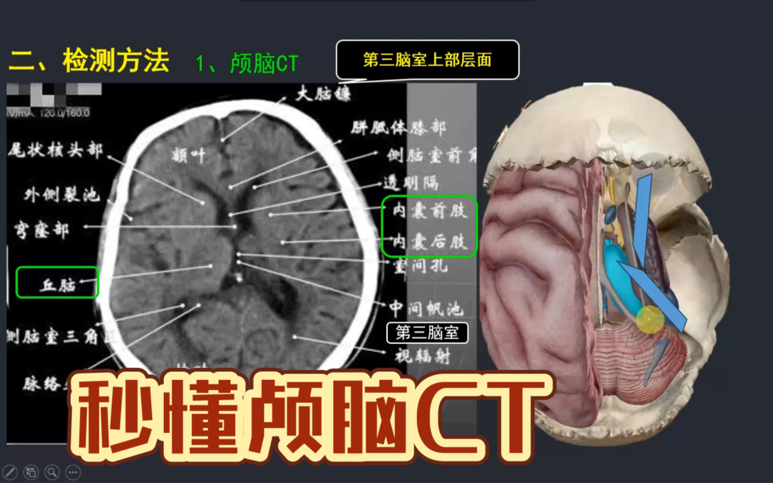 一个视频掌握颅脑CT哔哩哔哩bilibili