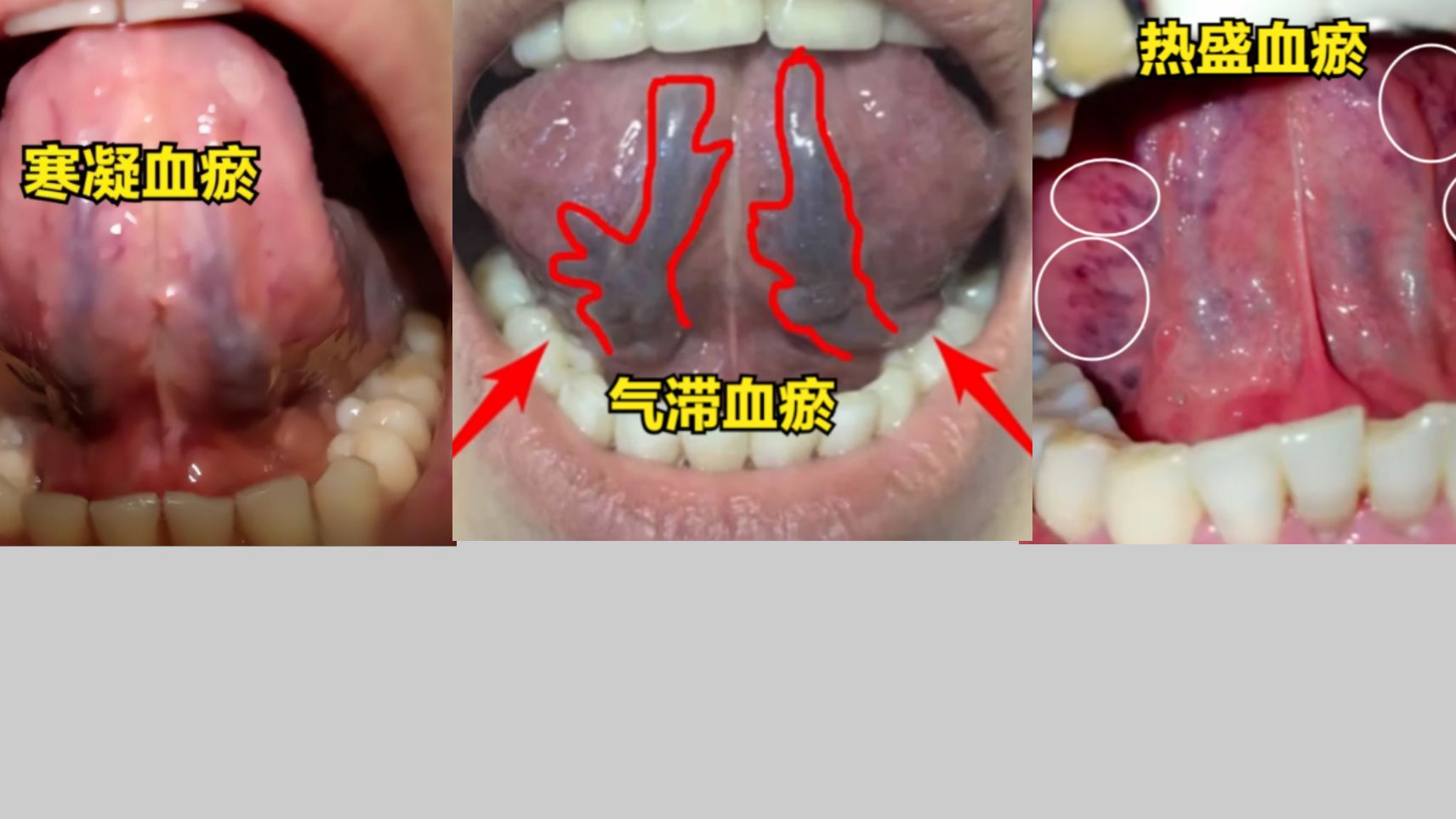 舌下出血点图片图片