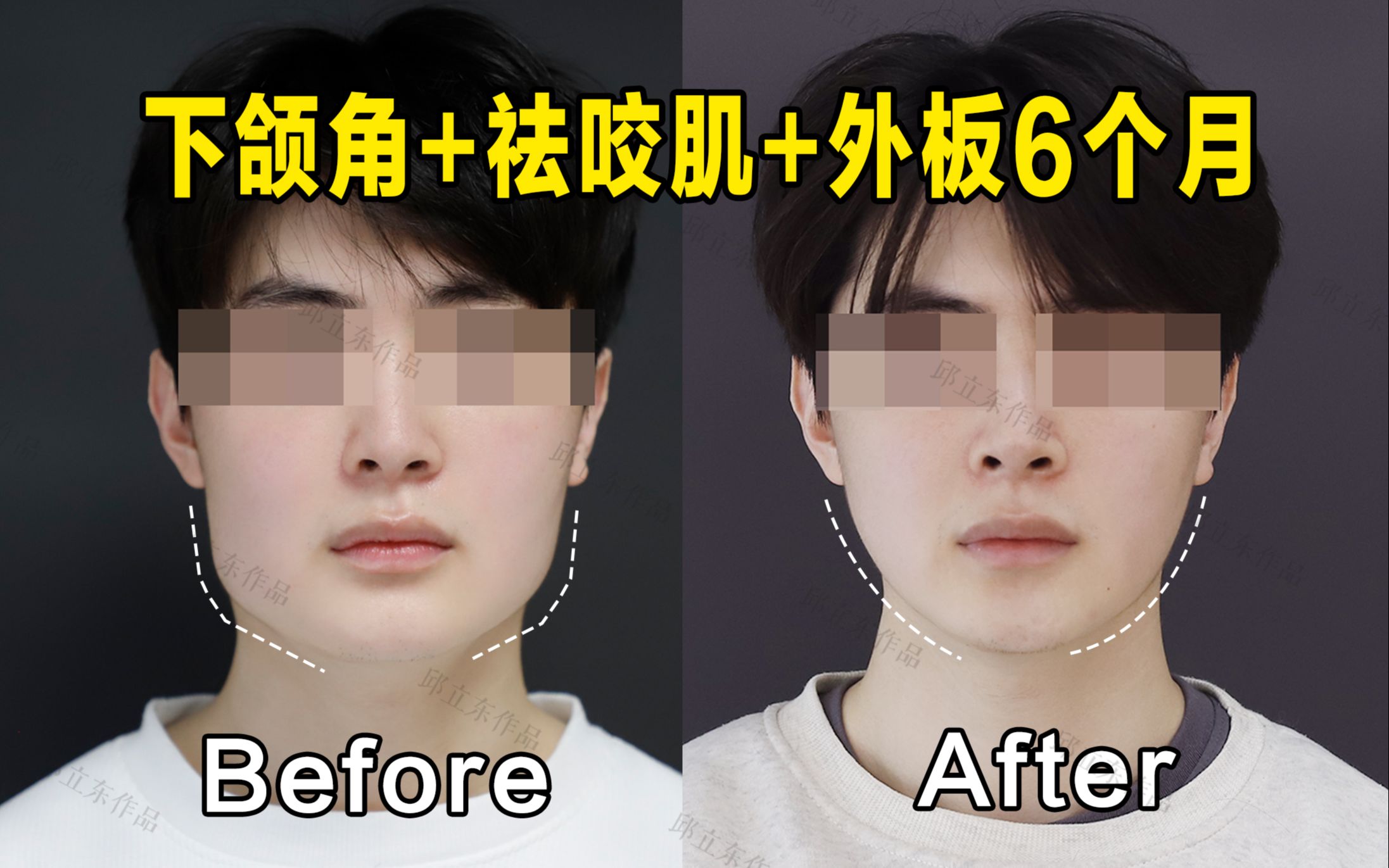 【邱立东】23岁江苏小哥,超长下颌角 祛外板咬肌6个月,脸小一圈儿更