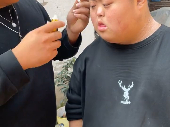 牛皮癣大王唐氏小鸭哥