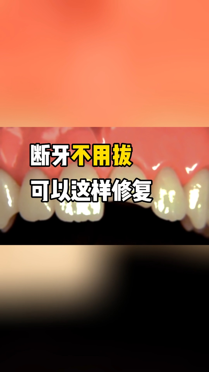 断牙不用拔,可以这样修复哔哩哔哩bilibili