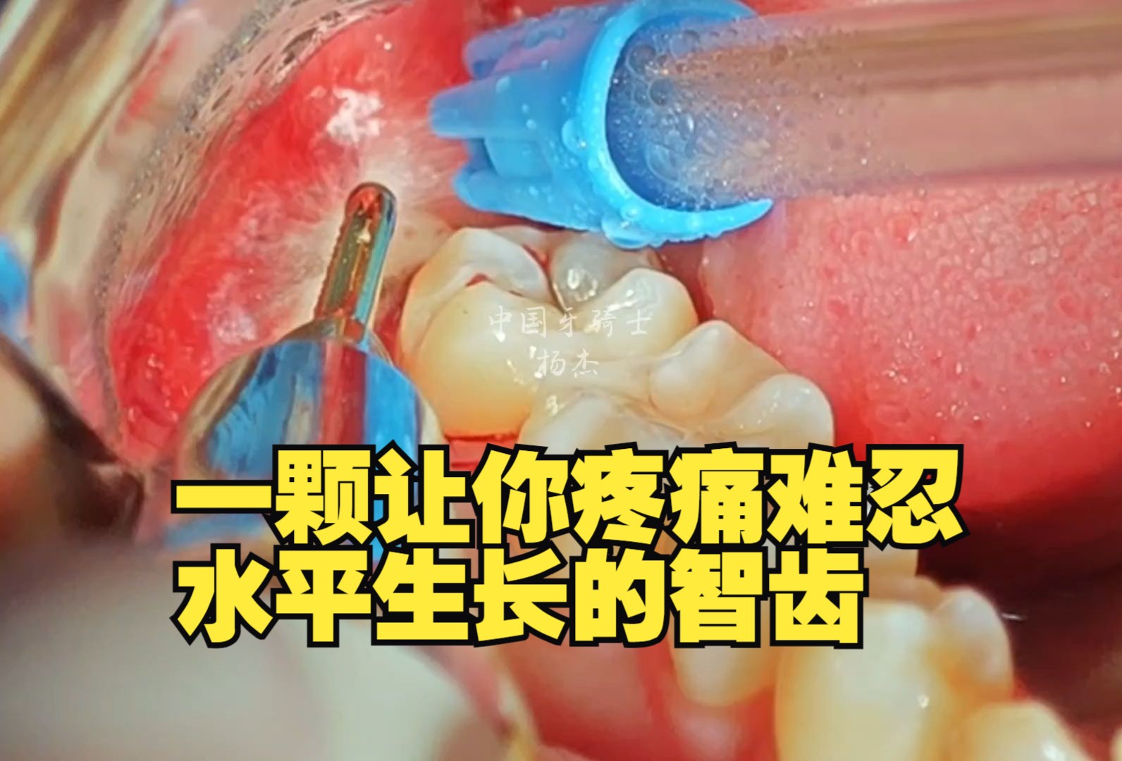 27岁小伙阻生智齿拔除全过程,前方高能