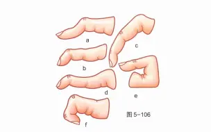 下载视频: 【骨关节功能解剖学】手的异常位置