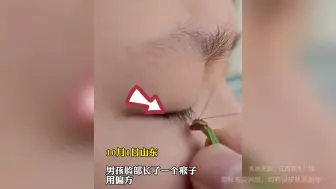 下载视频: 男孩儿脸部长了个肉瘊子，听偏方，抓了只螳螂把肉瘊子吃干净了!