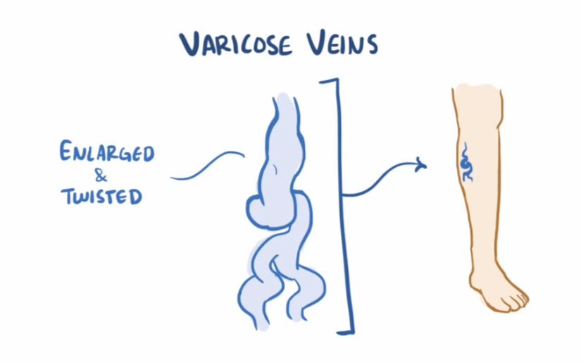 [图]【搬运osmosis】Varicose veins & chronic venous insufficiency (CVI)