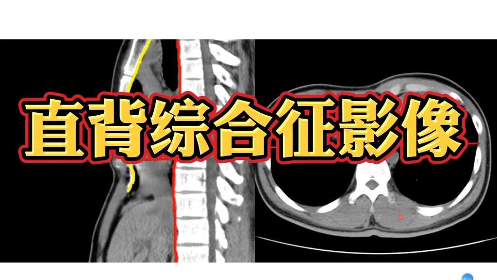 直背综合征在CT上诊断要点是什么?放射科医生讲解!哔哩哔哩bilibili