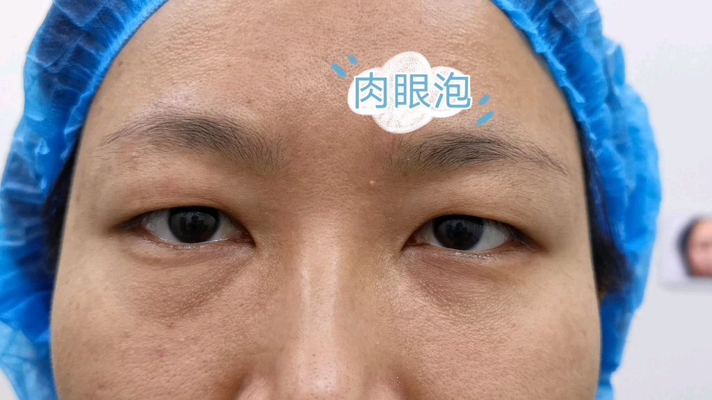 瞧瞧女士的大肉眼泡这么明显,可把姑娘愁坏了,适合哪款双眼皮呢?