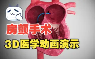 Download Video: 3D房颤手术演示动画