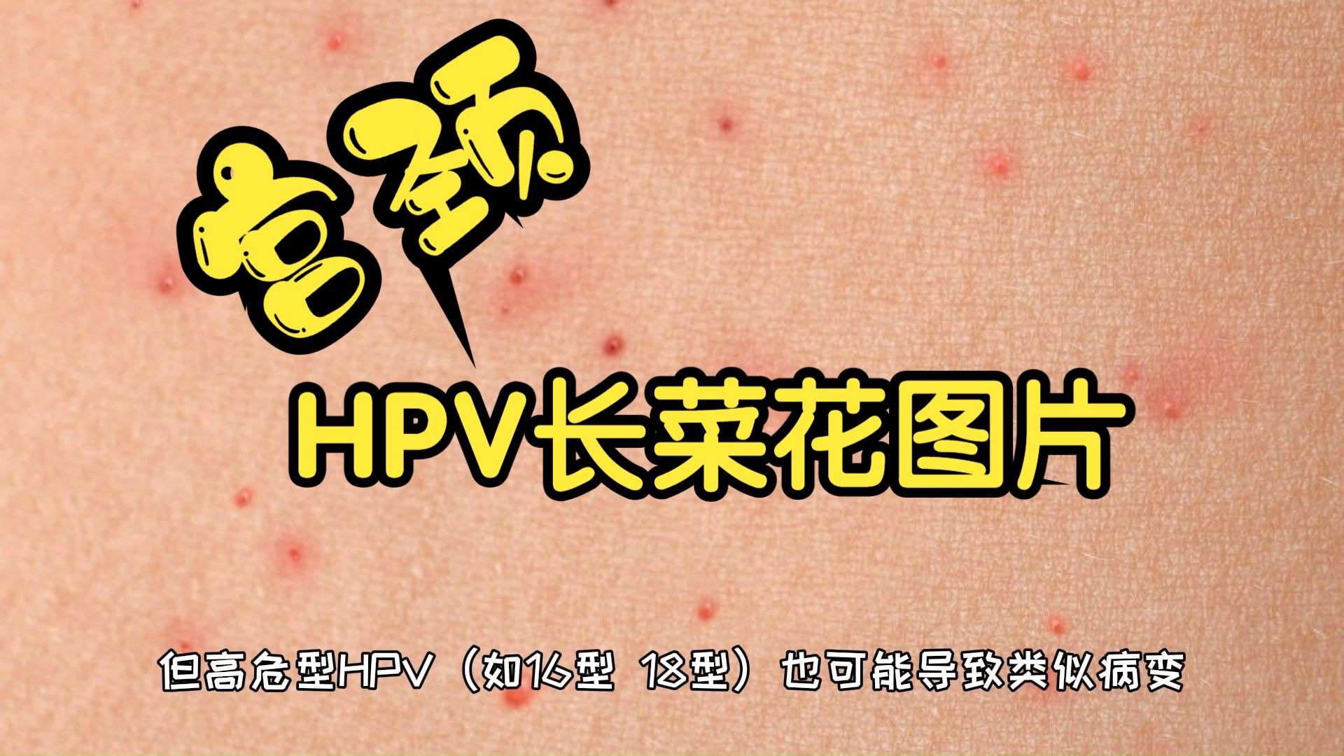 宫颈hpv长菜花图片