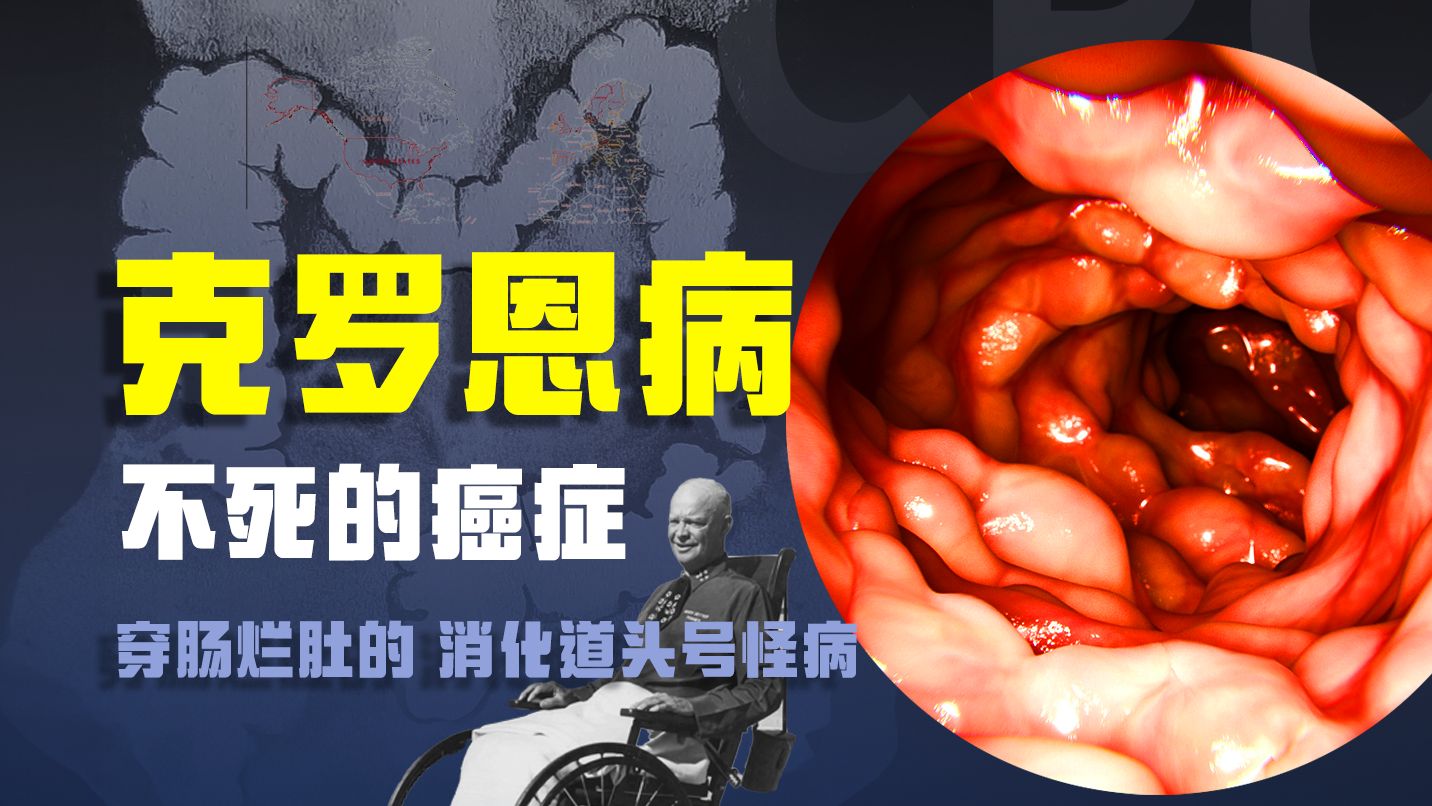 起初，人们以为这只是一次普通的腹泻...【克罗恩病】