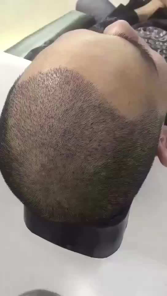 南京补发和植发选新生3d植发(南京补发和植发选新生3d植发哪家好)