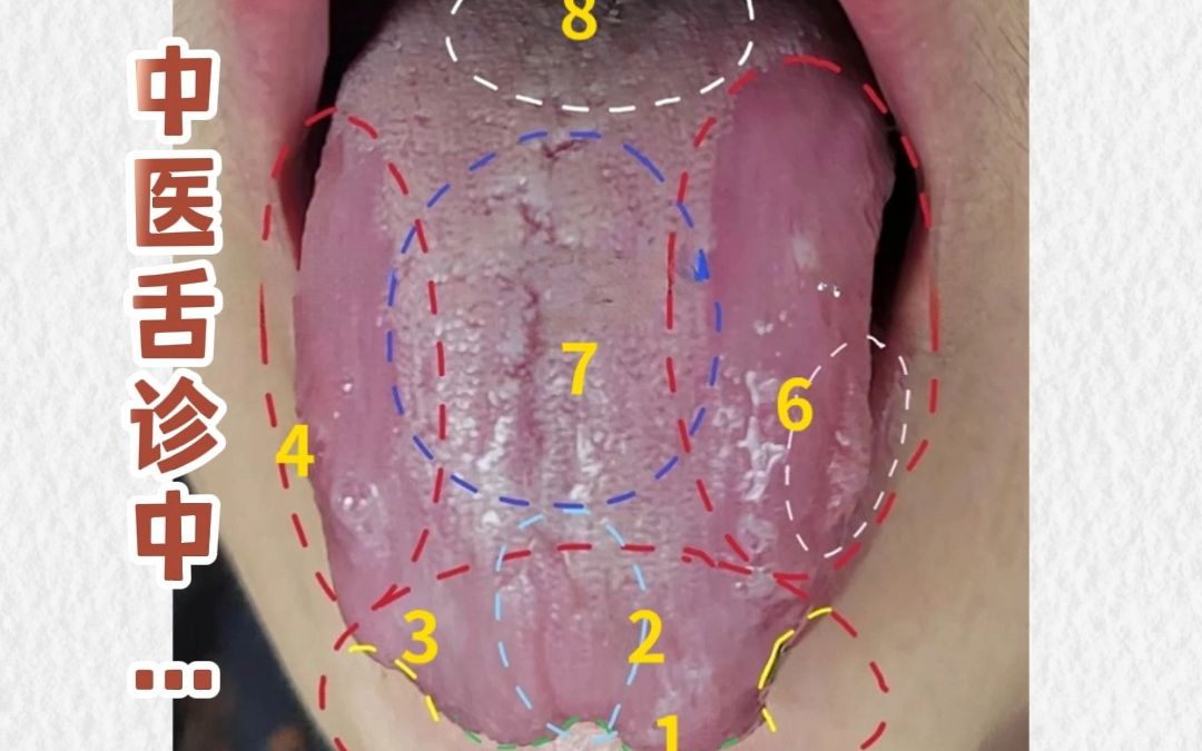 [图]中医临床舌象案例分析，手把手教你学舌诊！