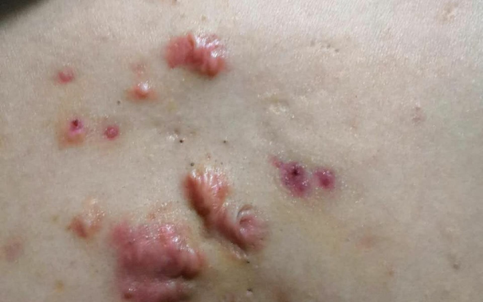 疤痕增生凸起淡化难,过来人每天坚持这几点,效果一天比一天好!