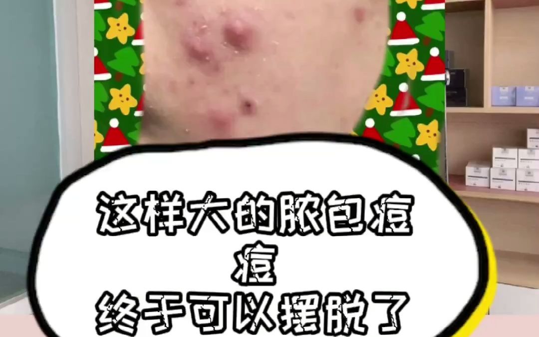 脸上长脓包痘痘怎么办,跟着我这样做!哔哩哔哩bilibili