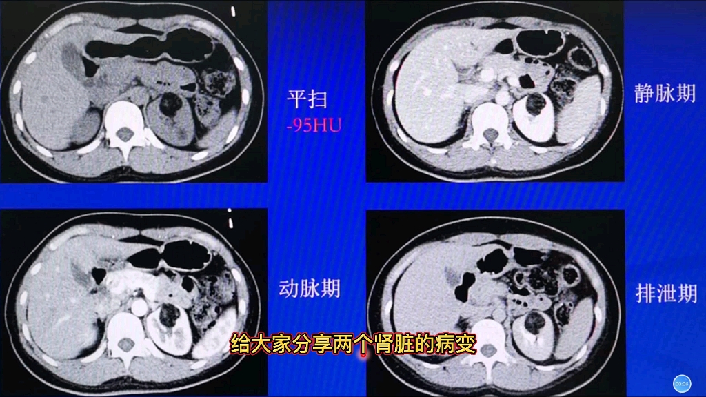 典型病例:发现肾脏占位,含脂肪成分,增强CT诊断什么?哔哩哔哩bilibili