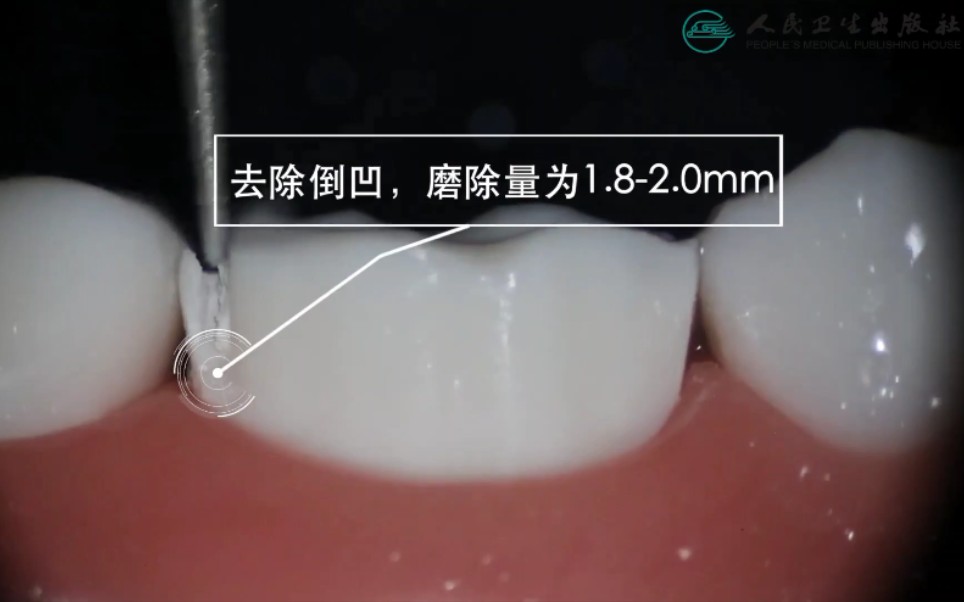 [图]下颌第一磨牙烤瓷冠牙体预备术