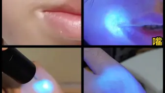 三年后,嘴角与手背的白癜风终于康复了  历时全纪录