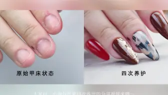 肉包甲矫正 这是第二次啦 第一次在之前教程主要是第一次比较长时间的处理让指缘皮有了很大改善下次来准备把甲片卸除到时给打击看看甲床的对比喜欢的宝宝记得点赞哦 哔哩哔哩 Bilibili