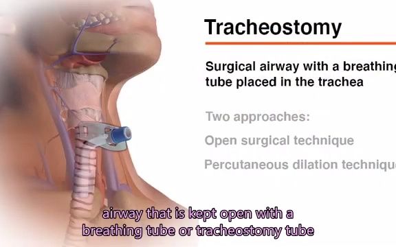 重症技术:经皮气管切开术(新英格兰医学杂志)哔哩哔哩bilibili