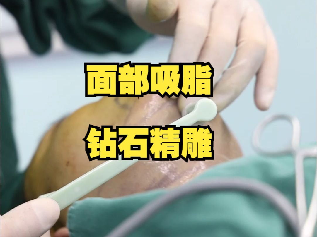 面部吸脂 钻石精雕,即刻清晰轮廓线!