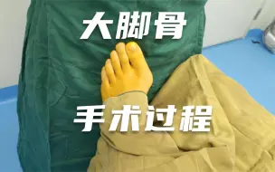 下载视频: 做大脚骨过程是怎么样的？看矫正大脚骨从术前到术后