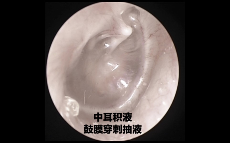(去色版)鼓膜穿刺抽液