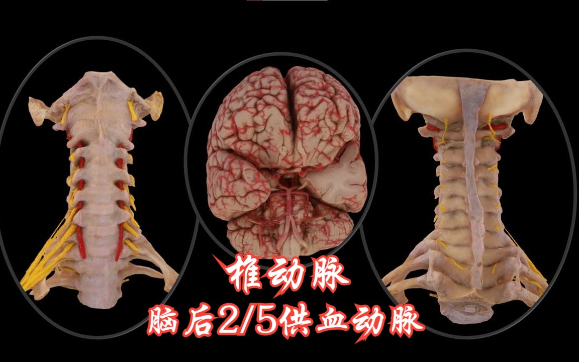 [图]椎动脉：脑后2/5的供血动脉