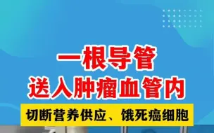 Download Video: 100根血管，仅一根通向肿瘤！1%精准绞杀癌细胞，直击肿瘤！