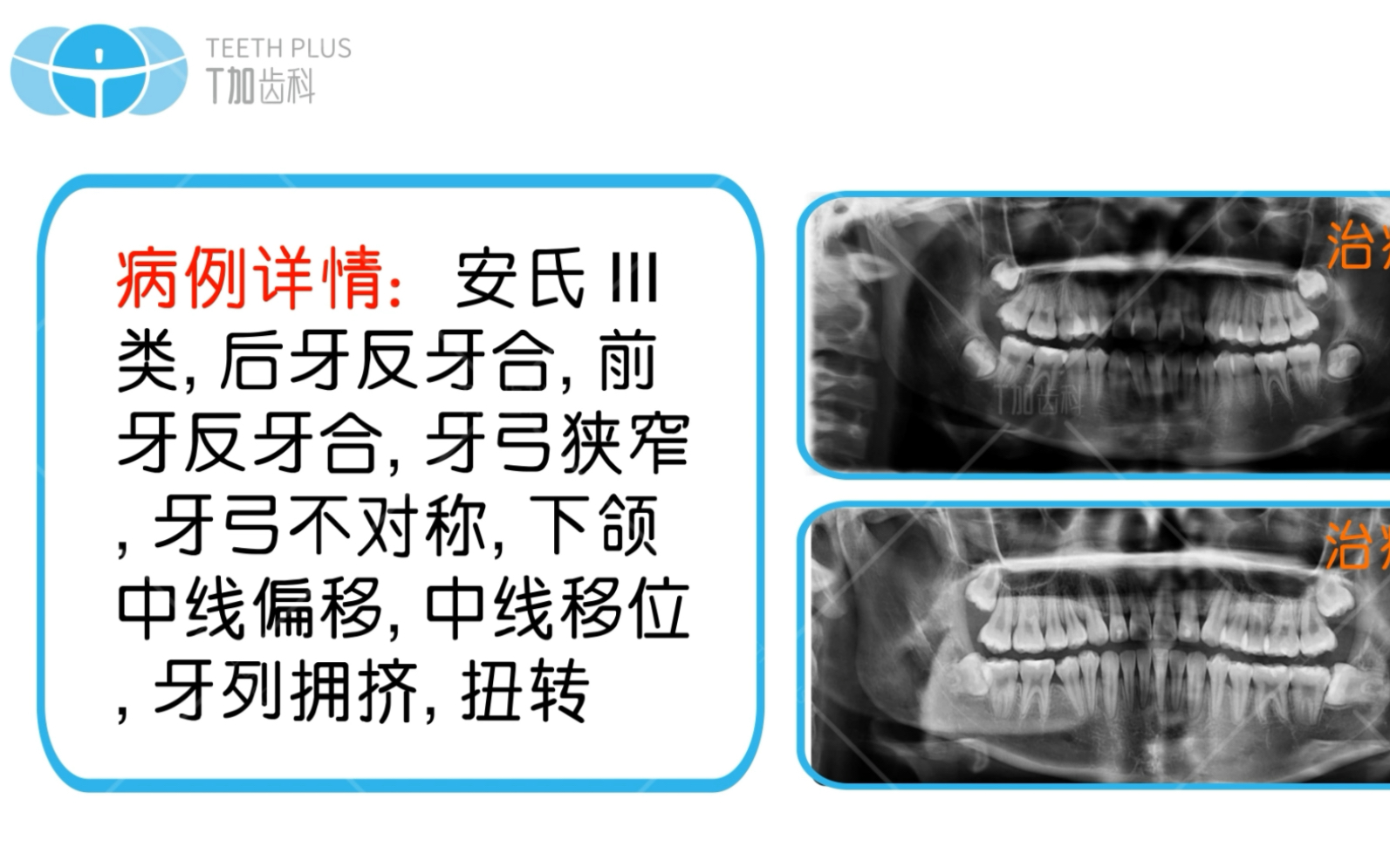 别再怕牙齿矫正踩坑了安氏三类近中错合,以正常上颌第1恒磨牙为参考下颌第1恒磨牙向近中的那一方向移动了,且伴有或不伴有错位牙,被称为安氏Ⅲ类,...