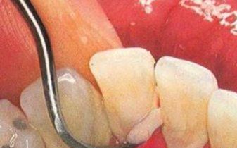 用显微镜放大牙垢1000倍会怎么样?