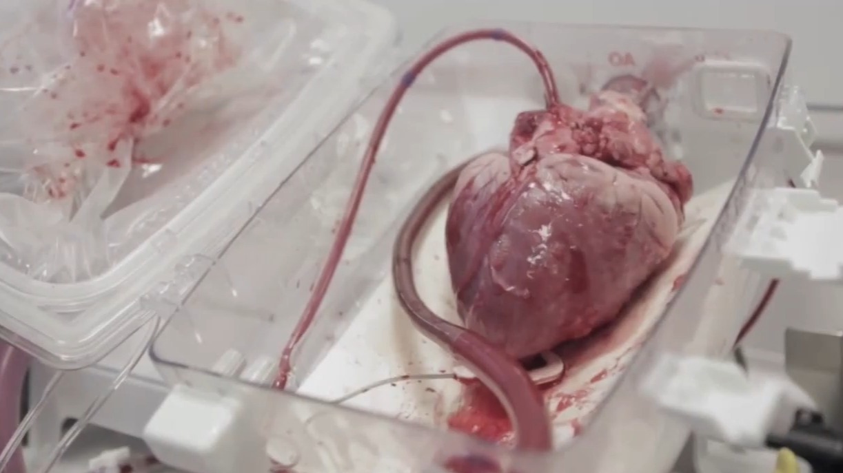 OCS体外心脏保存heartinabox
