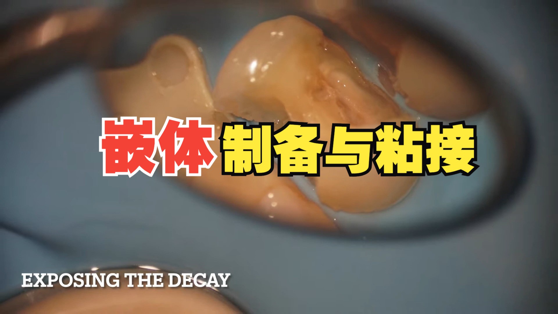 嵌体高嵌体的制备与粘接 inlay overlay preparation and bonding