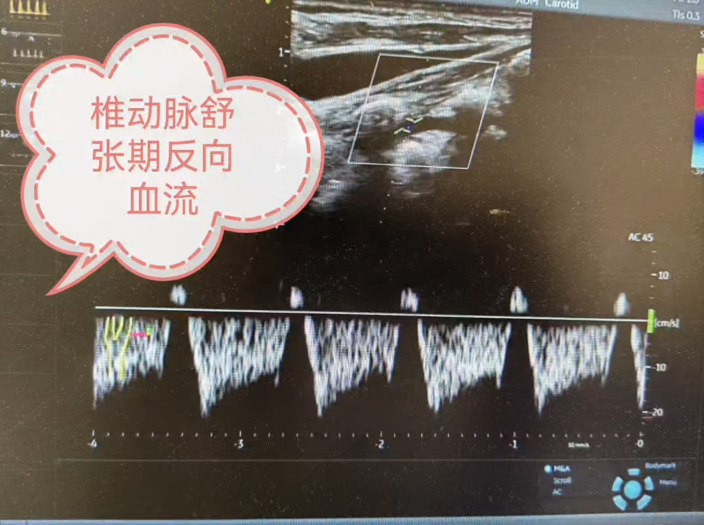 左侧锁骨下动脉图片