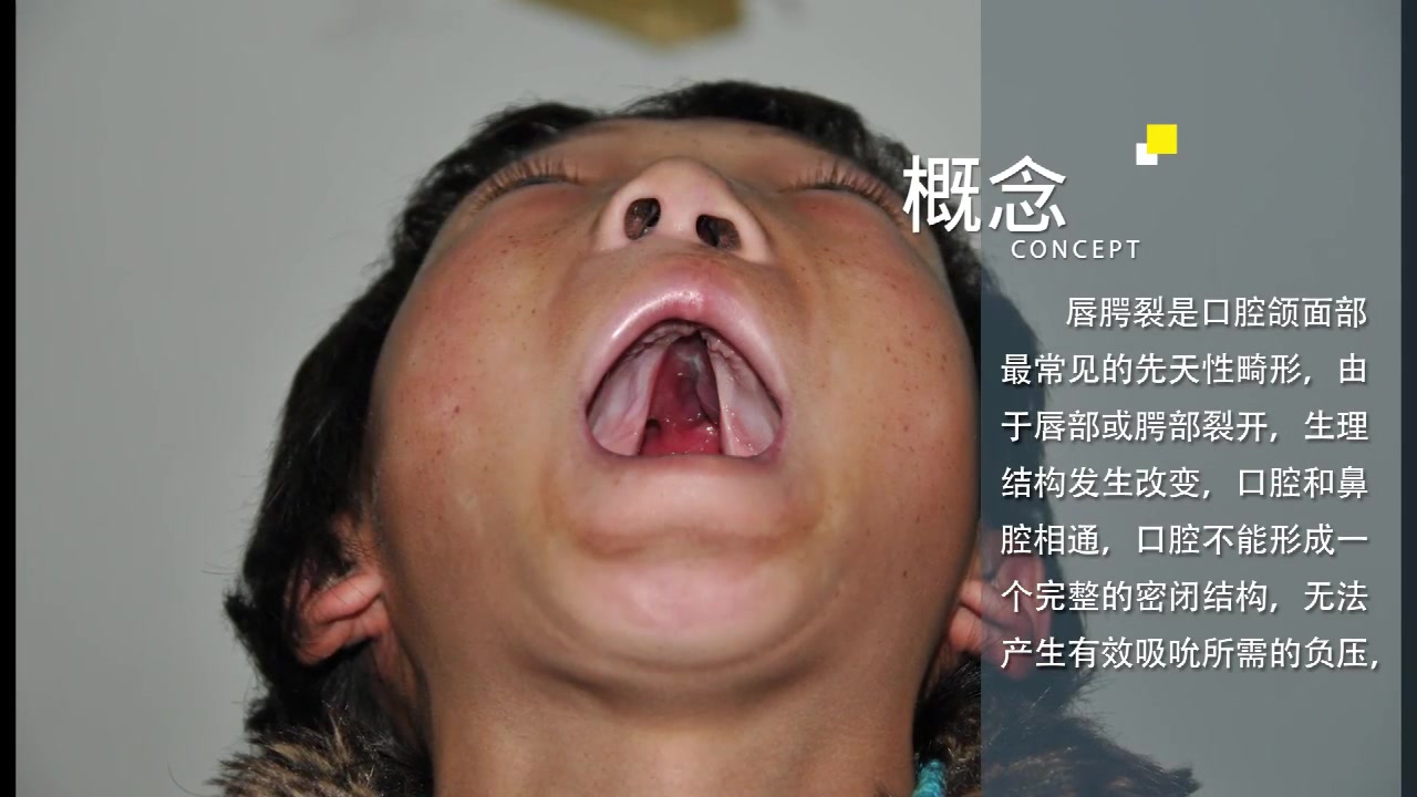 婴儿口腔软腭裂图片图片