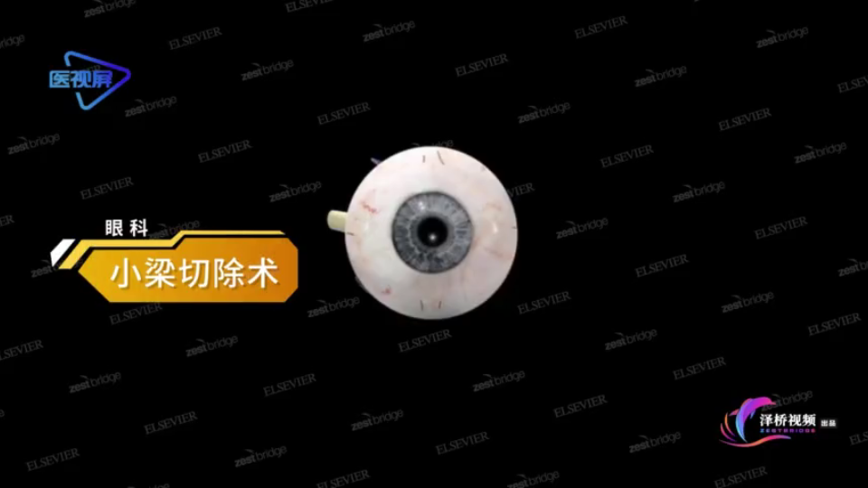 【医学3D】青光眼的治疗方法:小梁切除术哔哩哔哩bilibili