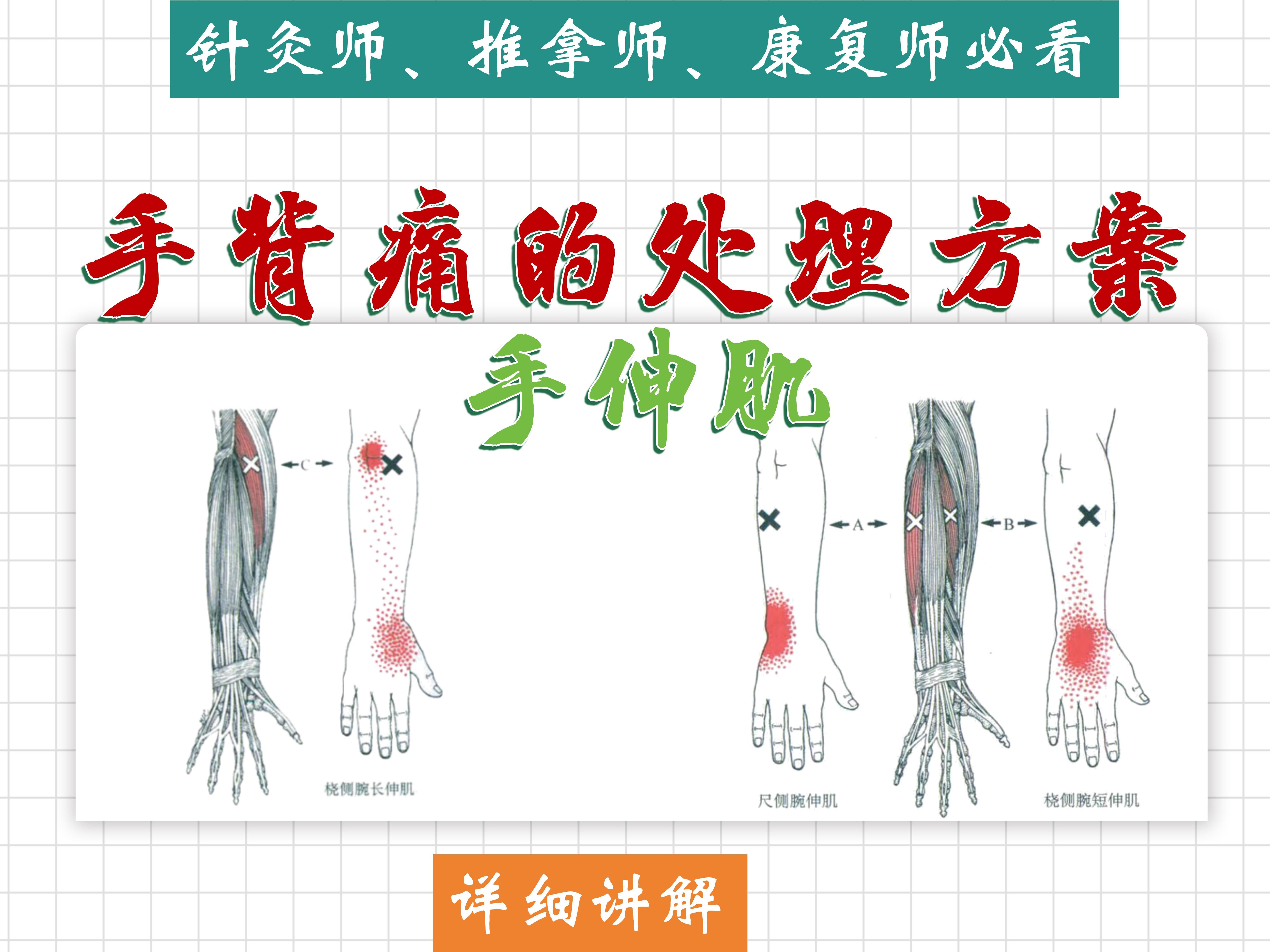 【手背痛】涉及肌肉(手伸肌)详细讲解——位置、功能、激痛点、处理方法——天下明医平台简灵奇针哔哩哔哩bilibili