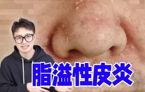 Download Video: 一到秋冬就T区脱皮？头油头痒？脂溢性皮炎又犯了！