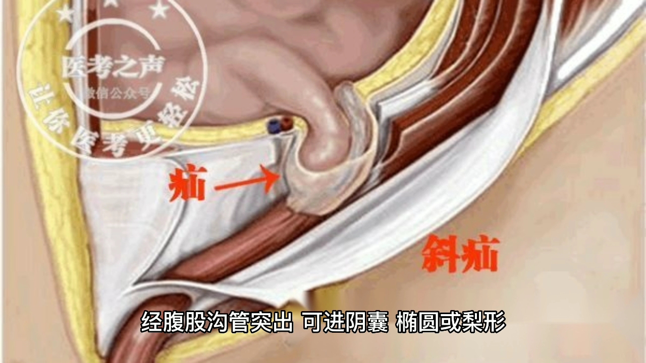 [图]腹外疝临床表现