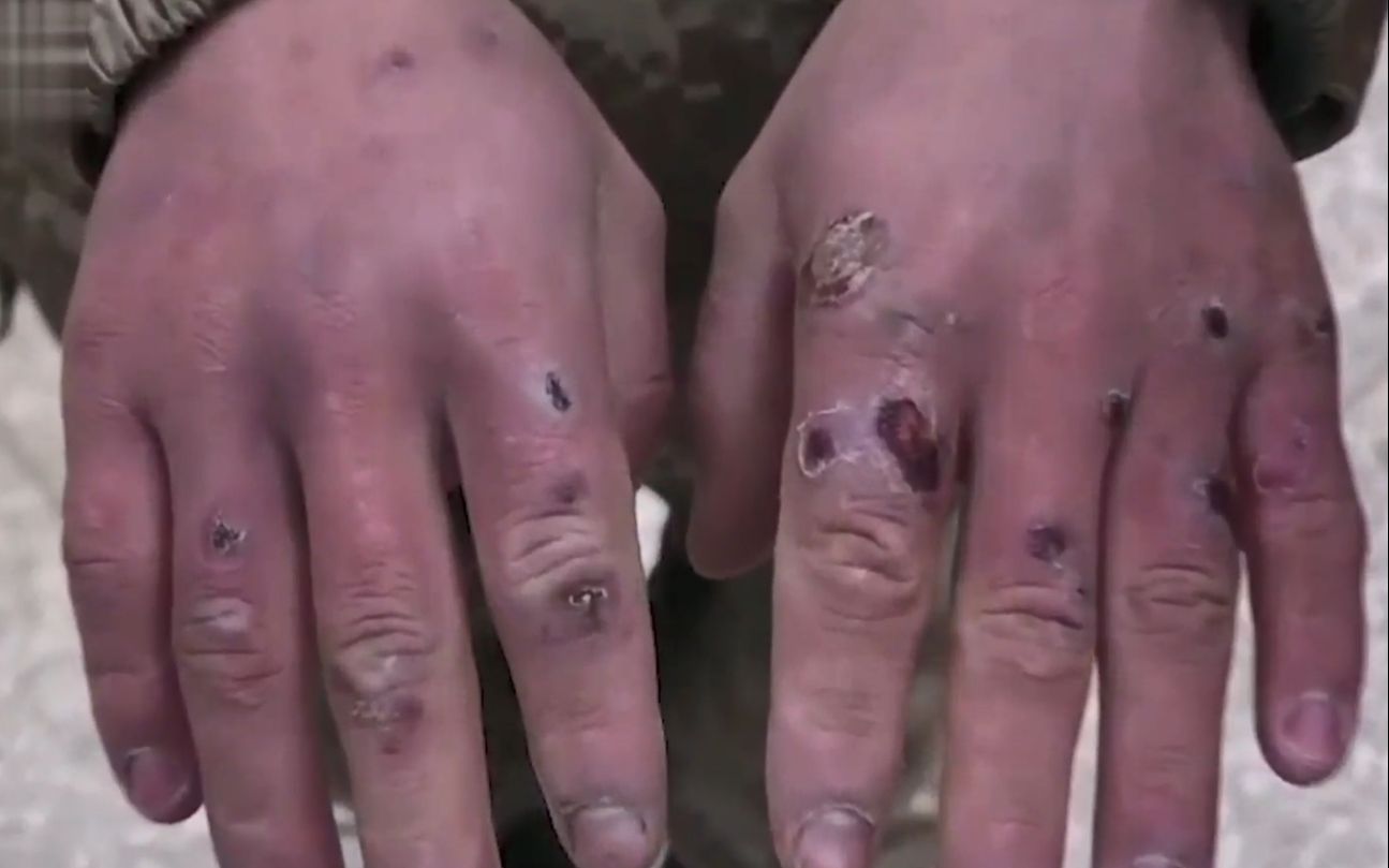 边防战士冻伤的手图片图片