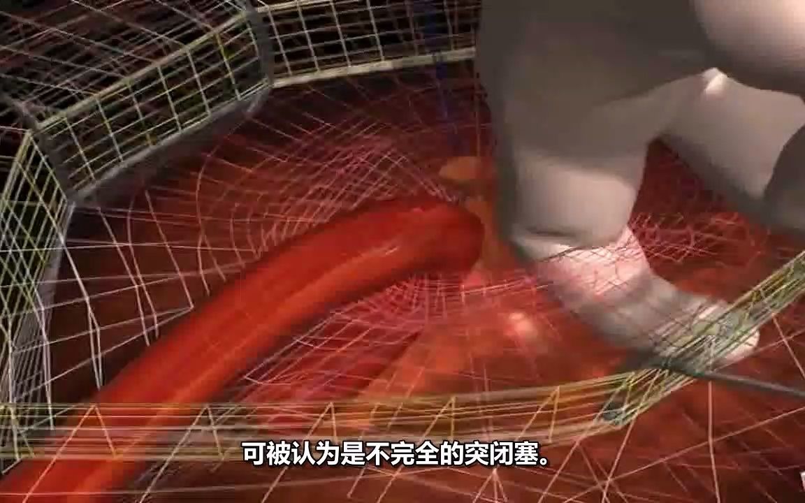 腹腔沟斜疝和直疝科普动画3d演示哔哩哔哩bilibili