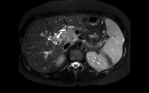 094 (胆总管远段胆管癌)Distal CBD Cholangiocarcinoma哔哩哔哩bilibili