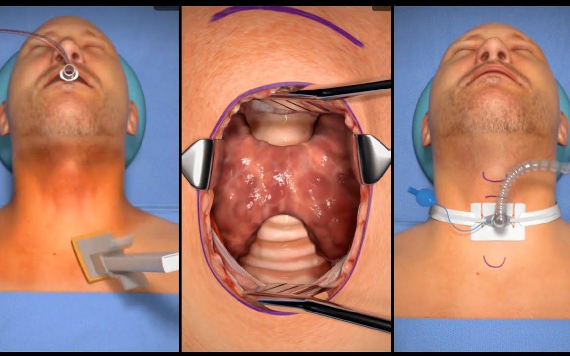 [图]气管切开术 | 学习急救知识 | 双语字幕