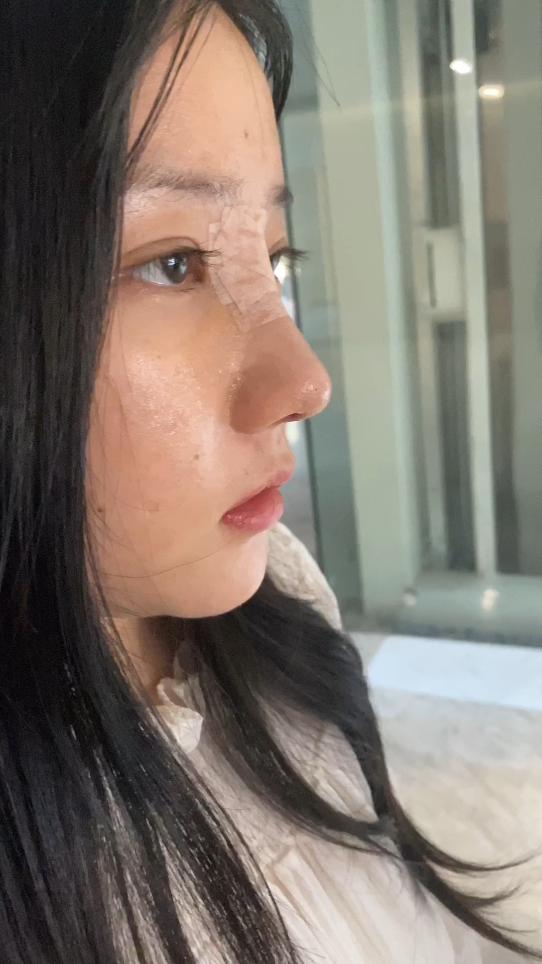 10天拆线,不知道好看不好看#肋骨鼻综合_哔哩哔哩_bilibili