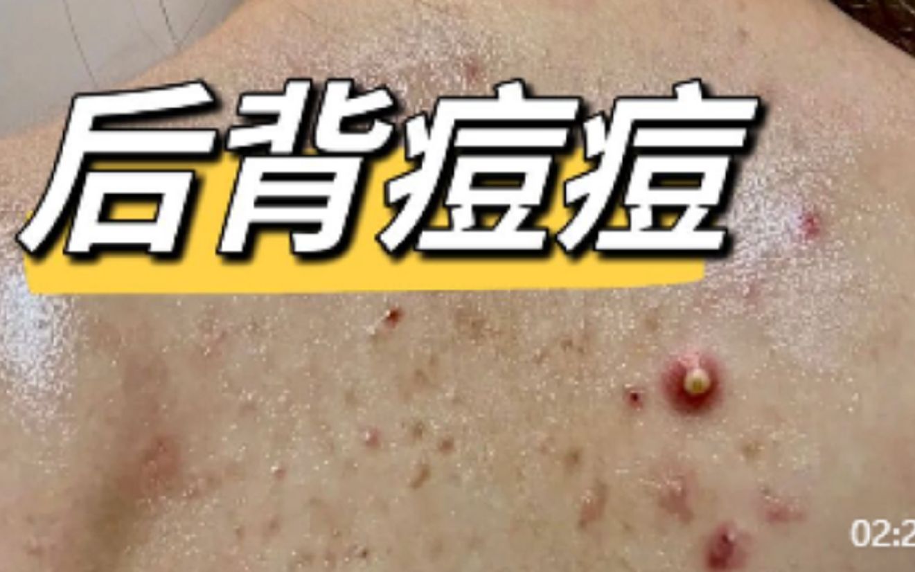 后背脓包痘痘反反复复!过来人支你三招,黑头,疙瘩洗洗就掉!