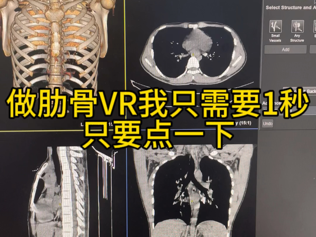 CT肋骨三维VR图一秒提取哔哩哔哩bilibili