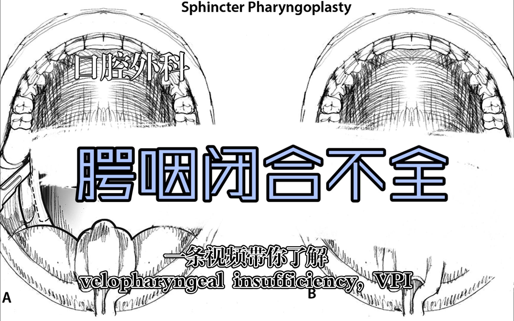 口外小课堂 腭咽闭合不全 VPI哔哩哔哩bilibili