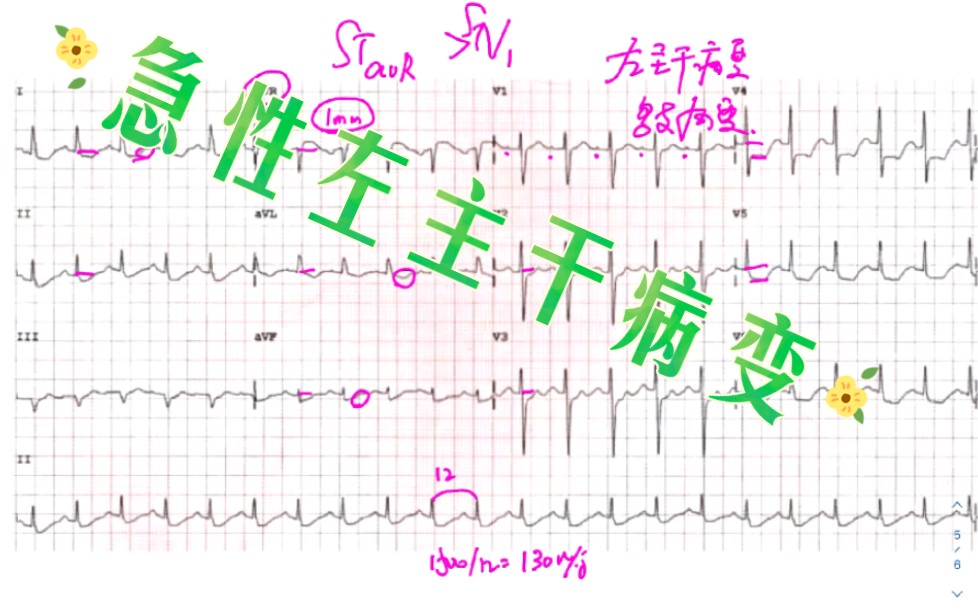 窦性心动过速,电轴轻度左偏,多导联st强烈提示冠状动脉左主干(LMCA)闭塞或严重多支血管病变.哔哩哔哩bilibili